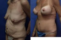 65 year old woman treated for massive weight loss