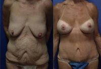 65 year old woman after major weight loss