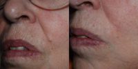 65-74 year old woman treated with Mole Removal