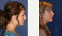 Dr. James A. Hoffman, MD, Saint Paul Plastic Surgeon - 19 Year Old Treated For Rhinoplasty