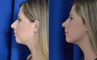 Dr. Sean R. Weiss, MD, FACS, New Orleans Facial Plastic Surgeon - 33 Year Old Woman Treated With Rhinoplasty In New Orleans