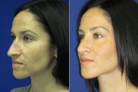 Rhinoplasty Before With Dr. Anthony Corrado, DO, Philadelphia Facial Plastic Surgeon