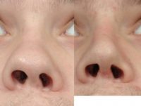 17 or under year old man treated with Rhinoplasty