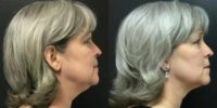 45-54 year old woman successfully treated Double Chin with CoolSculpting