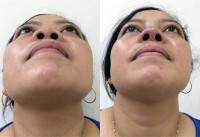 Asian rhinoplasty before and after nose implant