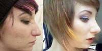 Before and after nose job rhinoplasty