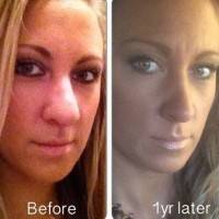Before and after rhinoplasty pictures 1 year later