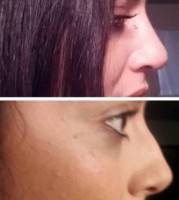 Nose surgery - rhinoplasty picture