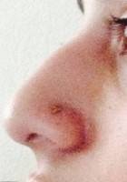 Rhinoplasty nostril scars photo