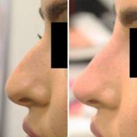 non surgical nose job with radiesse before and after