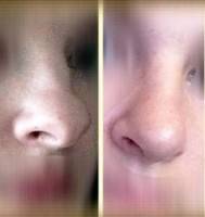 rhinoplasty bulbous tip before and after pics