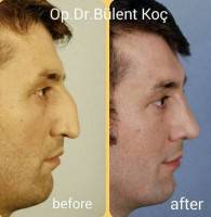 Best nose surgeon before and after