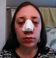 Breathing through nose after rhinoplasty during recovery