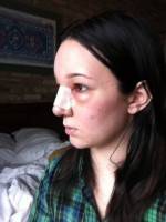 How long is recovery after rhinoplasty surgery
