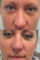 How much does rhinoplasty cost photos before and after