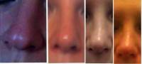 How much is a rhinoplasty surgery photos