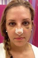 How to fix your nose without a nose job procedure