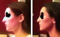 How to straighten a crooked nose with using of rhinoplasty