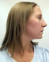 Image of nose job without breaking bone