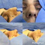 Indications For Osteotomies In Rhinoplasty Are Anatomic Findings Of A High Nasal Dorsum