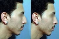 Male Rhinoplasty before and after pictures