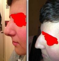 Male rhinoplasty before and after pictures