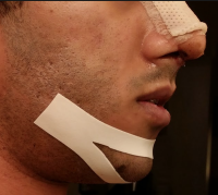 Male rhinoplasty before and after recovery