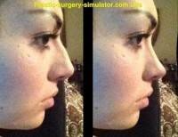 Nasal dorsal hump reducing before and after