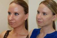 Nasal tip rhinoplasty before and after