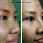 Non surgical nose job before after gallery