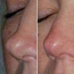 Non surgical nose job before after images