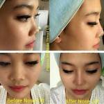 Non surgical nose job before after images of best surgeons