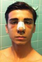 Nose job male bruises