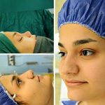 Not All Rhinoplasties Require The Use Of A Form Of Osteotomy