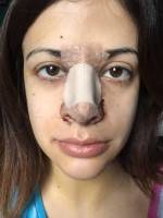 Open nose job rhinoplasty swelling