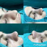 Osteotomy Nose Before And After (3)