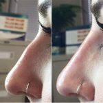 Osteotomy Nose Before And After (4)