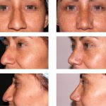 Osteotomy Nose Procedure Pic