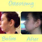 Osteotomy Rhinoplasty Before After (1)