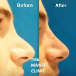 Osteotomy Rhinoplasty Before After (4)