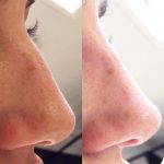Osteotomy Rhinoplasty Before After (5)