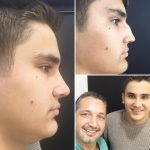 Osteotomy Rhinoplasty Before After (7)