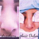 Osteotomy Rhinoplasty Before After (8)