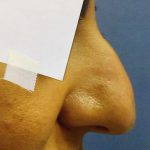 Osteotomy Rhinoplasty Is An Operation In Which A Bone Is Divided Or A Piece Of Bone Is Excised
