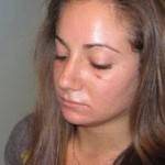 Pictures of rhinoplasty Denver cosmetic surgeons