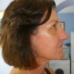 Pictures of rhinoplasty Perth top best plastic surgeons pictures
