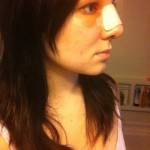 Pictures of rhinoplasty asian shapshot