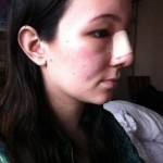 Pictures of rhinoplasty free