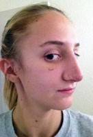 Pictures of rhinoplasty of alternative image