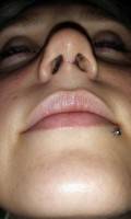 Pinched tip rhinoplasty picture
